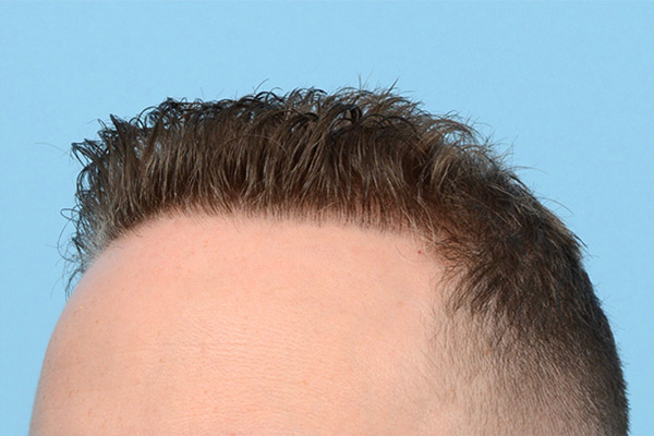 Follicular Unit Extraction (FUE) hair restoration — Patient 173 photo 6