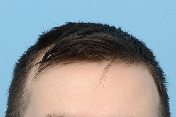 Follicular Unit Extraction (FUE) hair restoration — Patient 174 photo 1