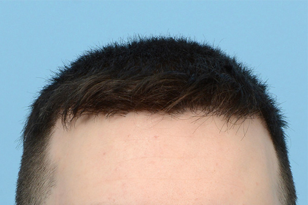 Follicular Unit Extraction (FUE) hair restoration — Patient 174 photo 2