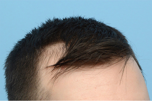 Follicular Unit Extraction (FUE) hair restoration — Patient 174 photo 3