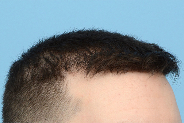 Follicular Unit Extraction (FUE) hair restoration — Patient 174 photo 4