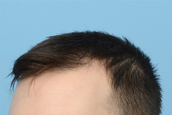 Follicular Unit Extraction (FUE) hair restoration — Patient 174 photo 5