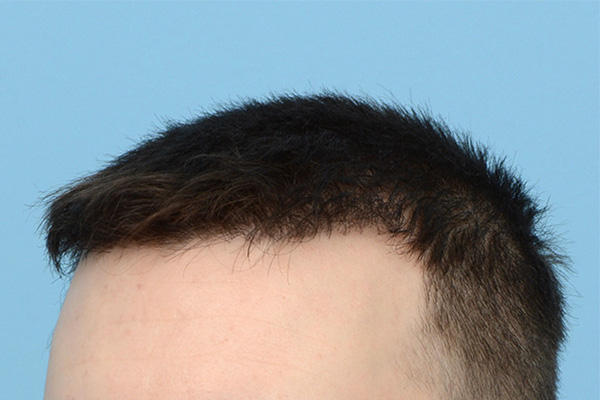 Follicular Unit Extraction (FUE) hair restoration — Patient 174 photo 6
