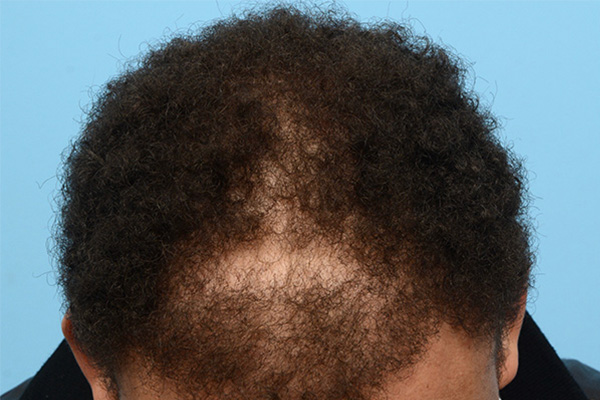 Follicular Unit Extraction (FUE) hair restoration — Patient 175 photo 1