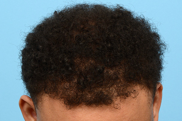 Follicular Unit Extraction (FUE) hair restoration — Patient 175 photo 2