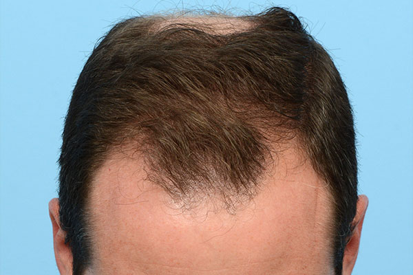 Fue Before and After | Dr. Jeffrey Wise