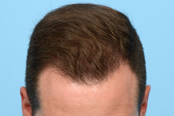 Fue Before and After | Dr. Jeffrey Wise