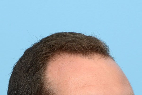 Fue Before and After | Dr. Jeffrey Wise