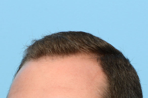 Fue Before and After | Dr. Jeffrey Wise