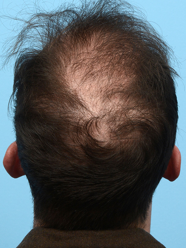 Fue Before and After | Dr. Jeffrey Wise