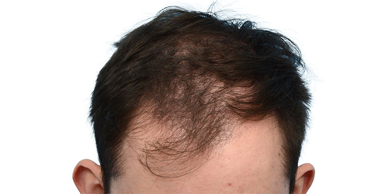 Fue Before and After | Dr. Jeffrey Wise