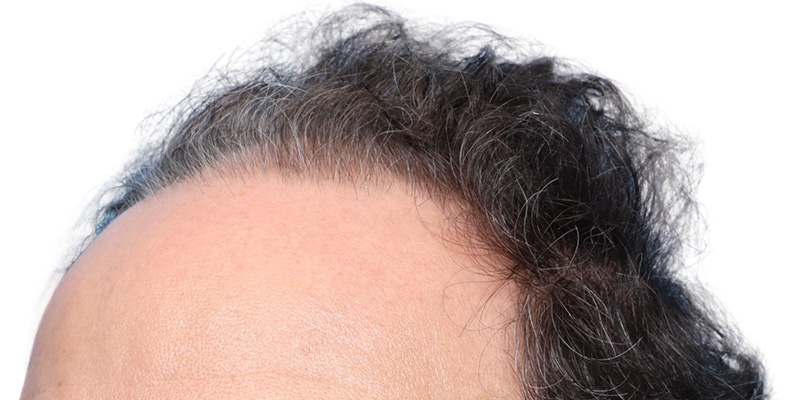 Fue Before and After | Dr. Jeffrey Wise