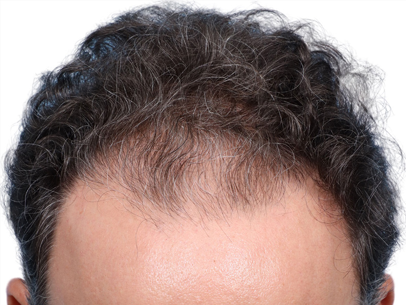 Fue Before and After | Dr. Jeffrey Wise