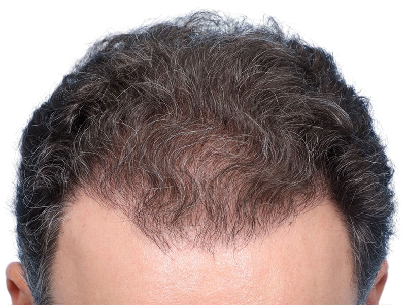 Fue Before and After | Dr. Jeffrey Wise