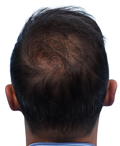 Fue Before and After | Dr. Jeffrey Wise