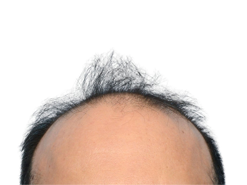Fue Before and After | Dr. Jeffrey Wise