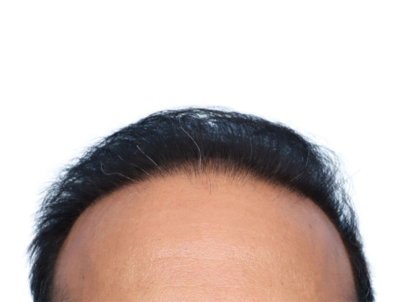 Fue Before and After | Dr. Jeffrey Wise