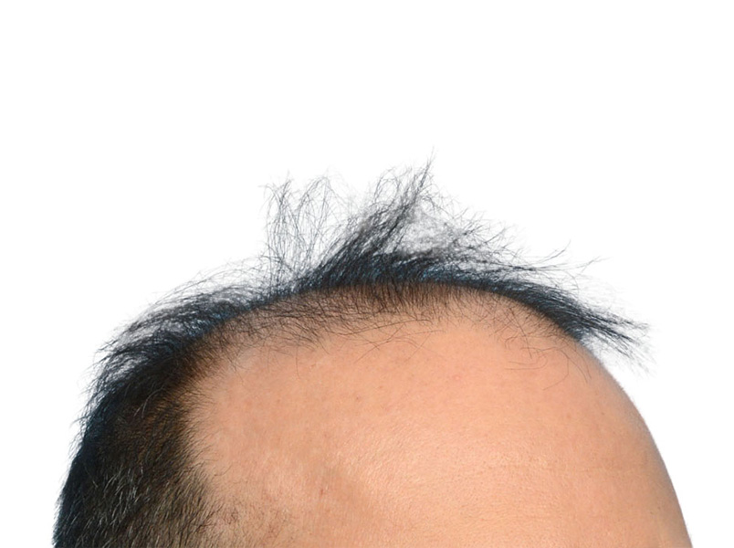 Fue Before and After | Dr. Jeffrey Wise