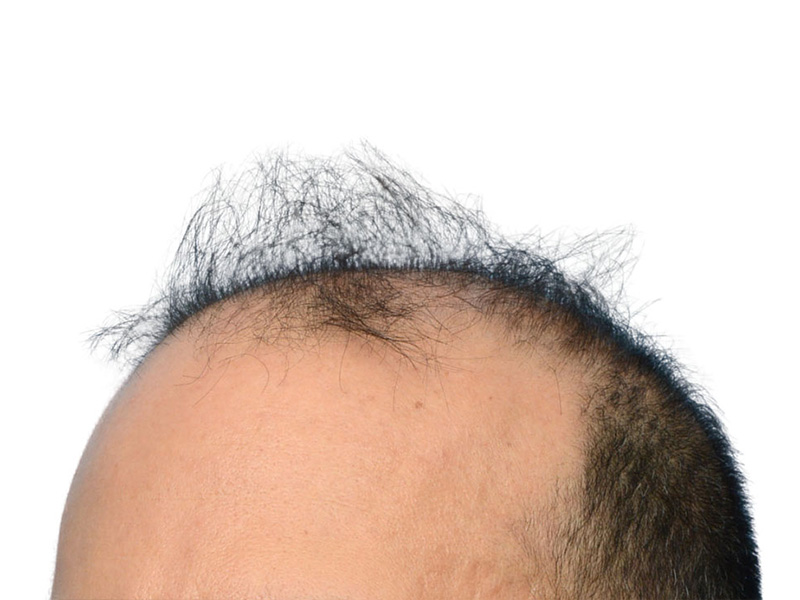 Fue Before and After | Dr. Jeffrey Wise