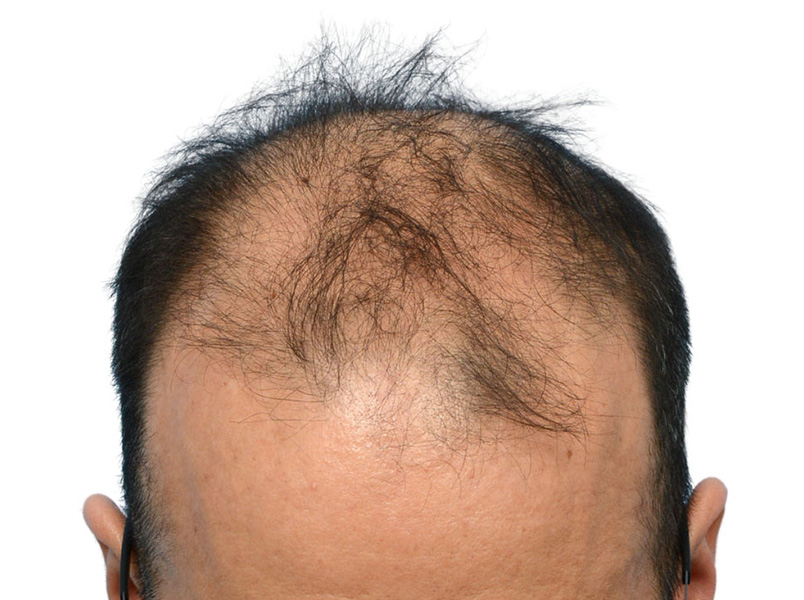 Fue Before and After | Dr. Jeffrey Wise