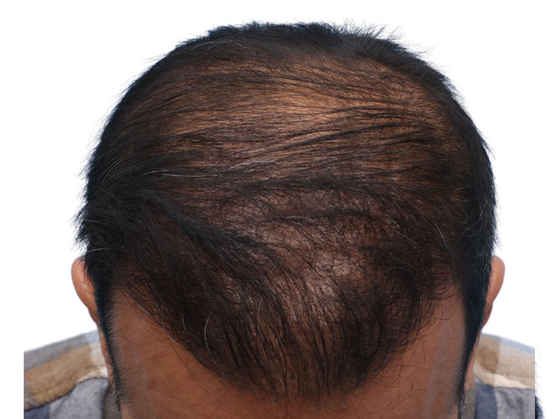 Fue Before and After | Dr. Jeffrey Wise