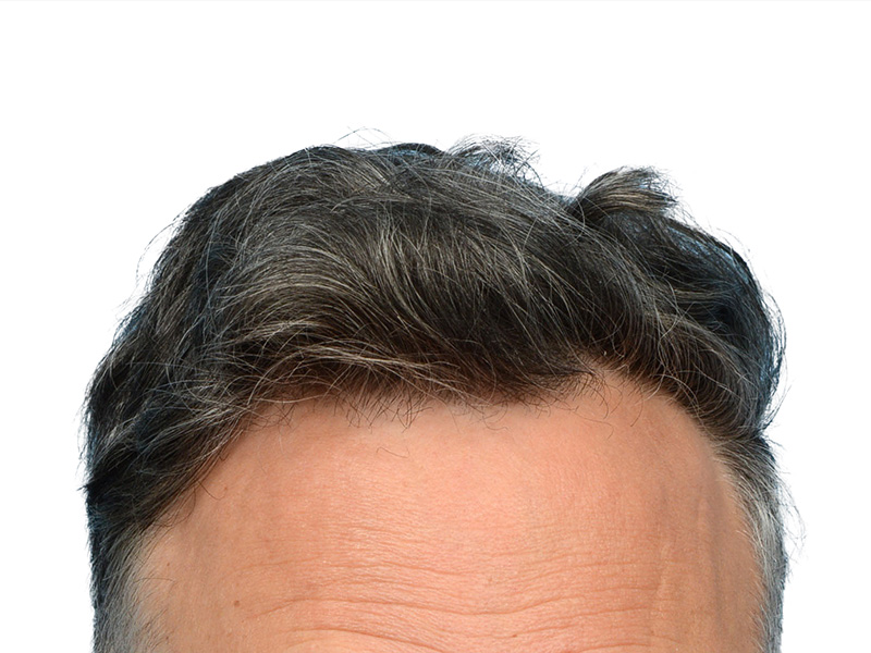 Fue Before and After | Dr. Jeffrey Wise