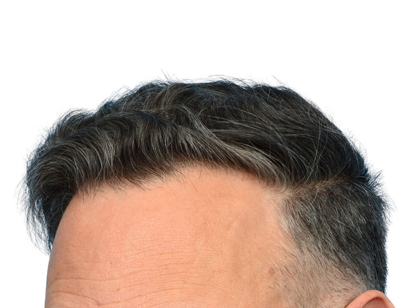 Fue Before and After | Dr. Jeffrey Wise
