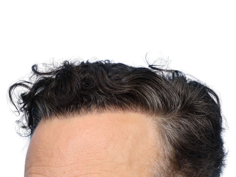 Fue Before and After | Dr. Jeffrey Wise