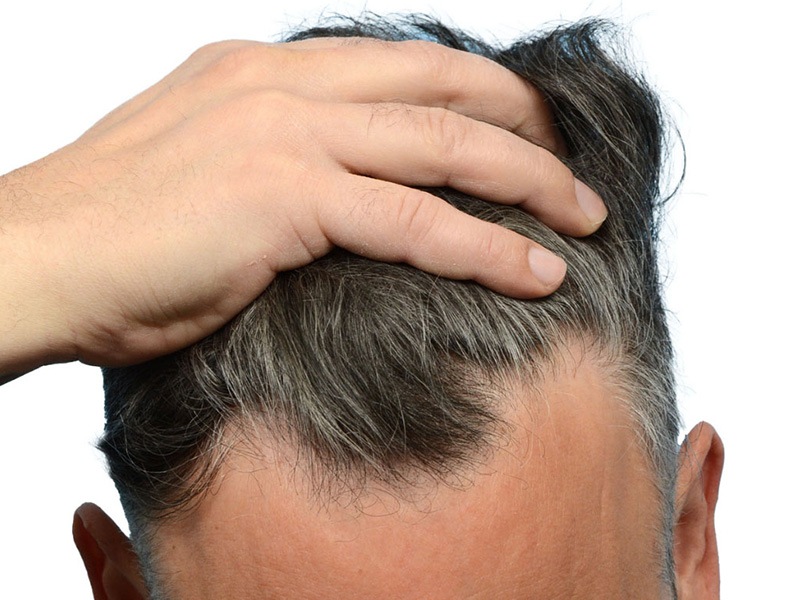 Fue Before and After | Dr. Jeffrey Wise