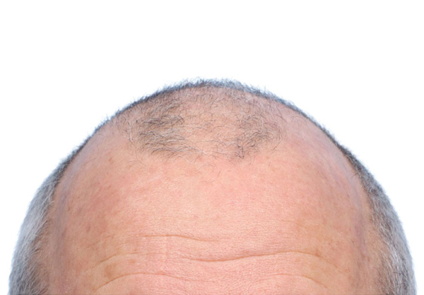 Fue Before and After | Dr. Jeffrey Wise