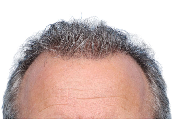 Fue Before and After | Dr. Jeffrey Wise