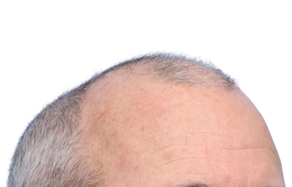 Fue Before and After | Dr. Jeffrey Wise