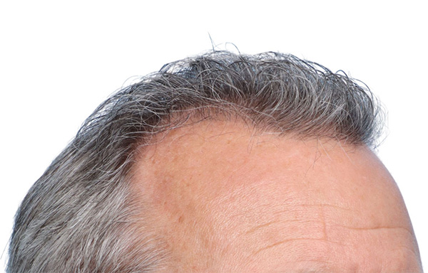 Fue Before and After | Dr. Jeffrey Wise