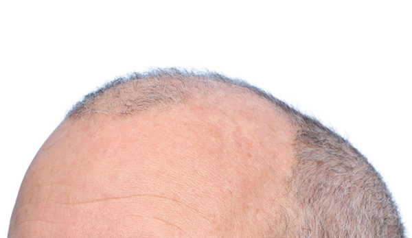 Fue Before and After | Dr. Jeffrey Wise