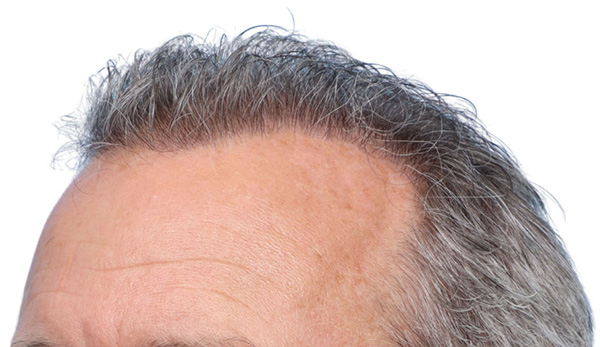 Fue Before and After | Dr. Jeffrey Wise