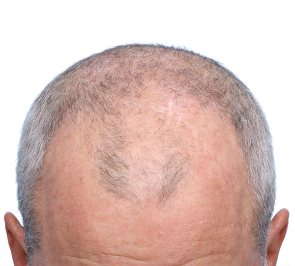 Fue Before and After | Dr. Jeffrey Wise
