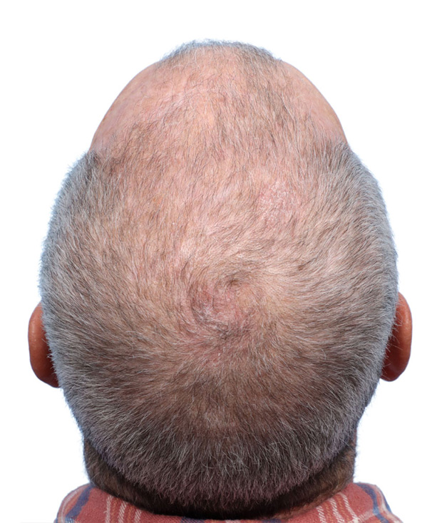Fue Before and After | Dr. Jeffrey Wise