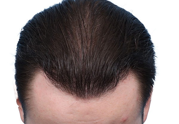 Fue Before and After | Dr. Jeffrey Wise