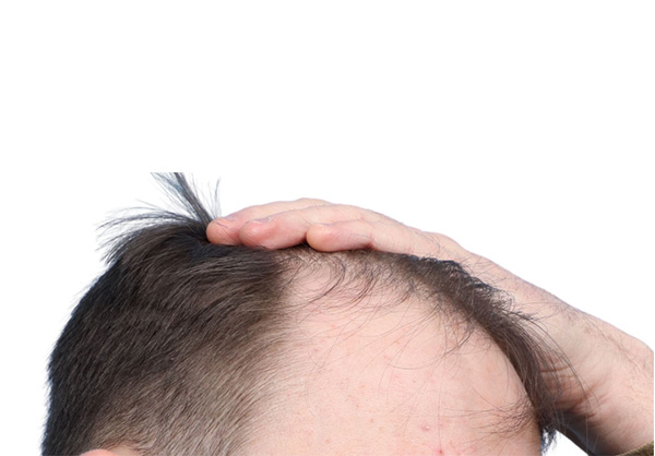 Fue Before and After | Dr. Jeffrey Wise