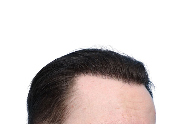 Fue Before and After | Dr. Jeffrey Wise