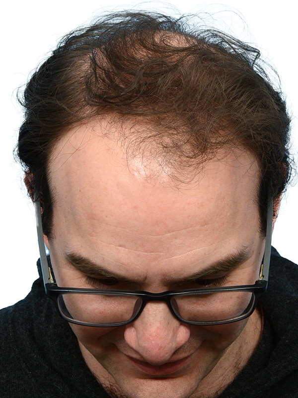 Fue Before and After | Dr. Jeffrey Wise