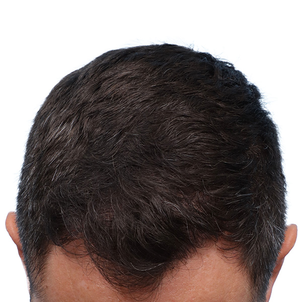 Fue Before and After | Dr. Jeffrey Wise
