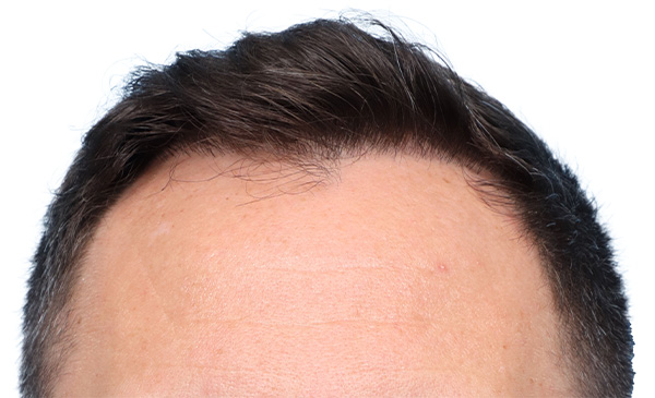 Fue Before and After | Dr. Jeffrey Wise