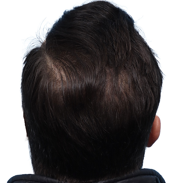 Fue Before and After | Dr. Jeffrey Wise