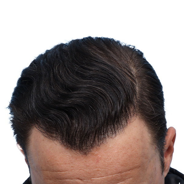 Fue Before and After | Dr. Jeffrey Wise