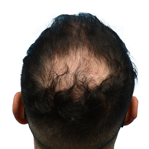 Fue Before and After | Dr. Jeffrey Wise