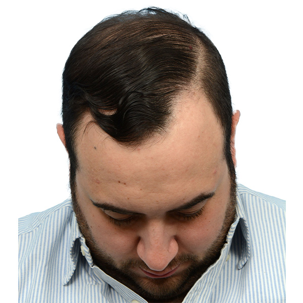 Fue Before and After | Dr. Jeffrey Wise