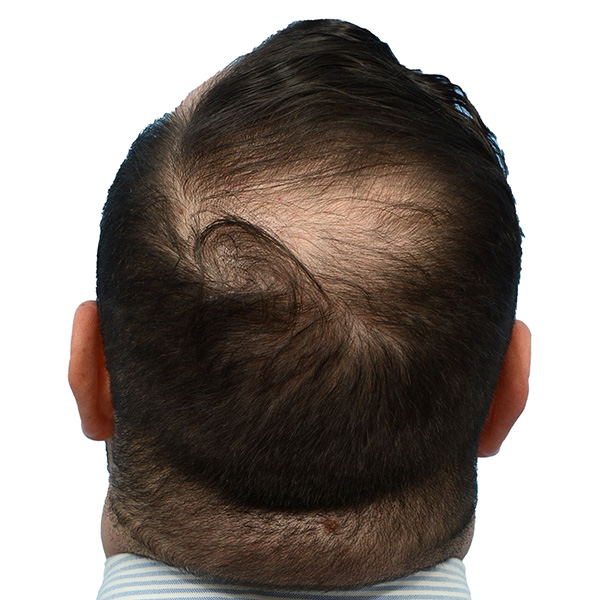 Fue Before and After | Dr. Jeffrey Wise