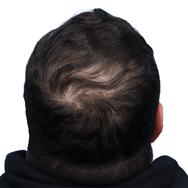 Fue Before and After | Dr. Jeffrey Wise