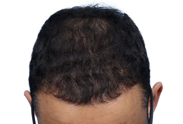 Fue Before and After | Dr. Jeffrey Wise
